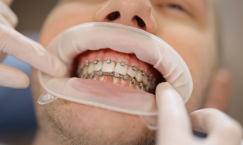 Orthodontic Treatment - Hildebrand Ortho