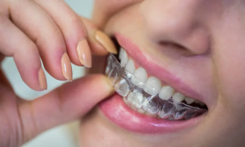 The Latest Innovations in Invisalign & Its Impact on Orthodontics