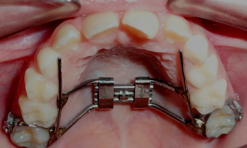 https://eadn-wc03-9188187.nxedge.io/wp-content/uploads/2023/01/What-are-the-Different-Types-of-Palatal-Expanders-Available-jpg.webp