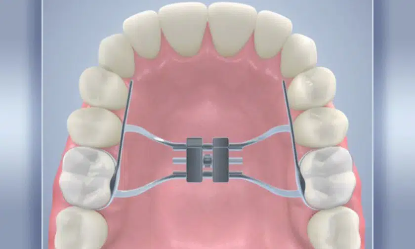 How Palatal Expanders Help with Common Dental Issues