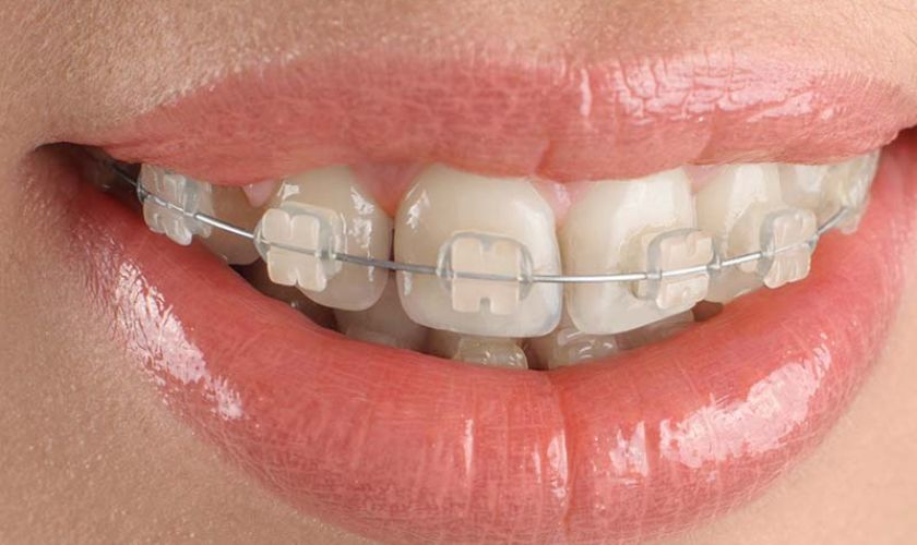 Clear braces in Arlington- Hildebrand Orthodontics
